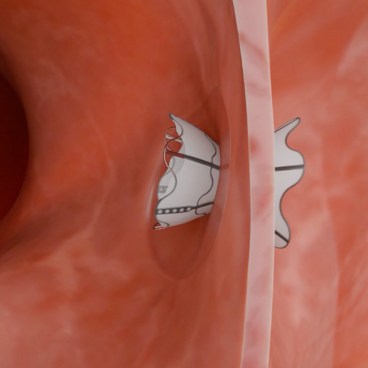 V-Wave™ Ventura Interatrial Shunt | VWaveMedical.com